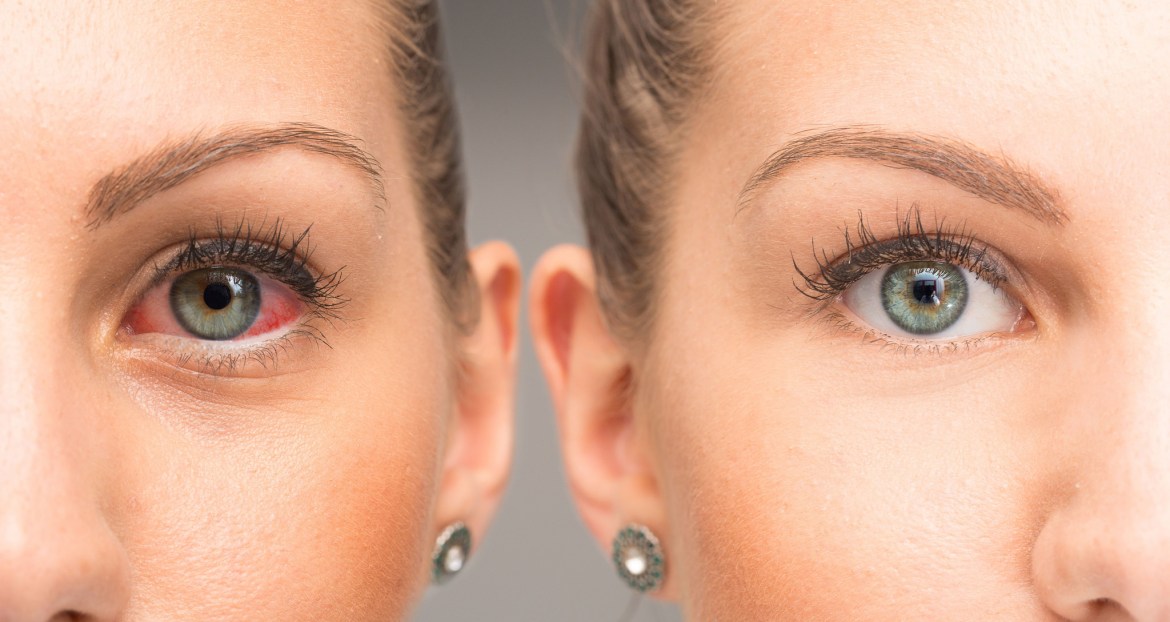 Kad oslijepiš kasno je: Naučite kako da prepoznate glaukom